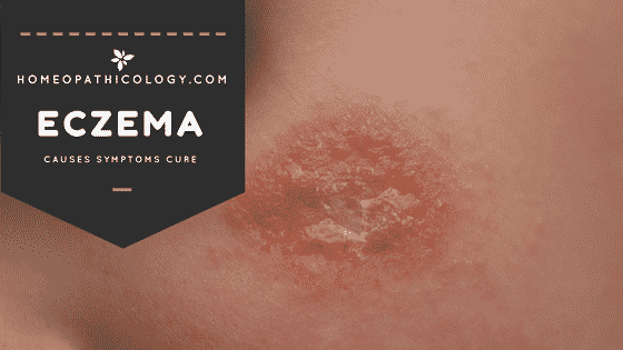ECZEMA Causes and Symptoms -Skin Diseases