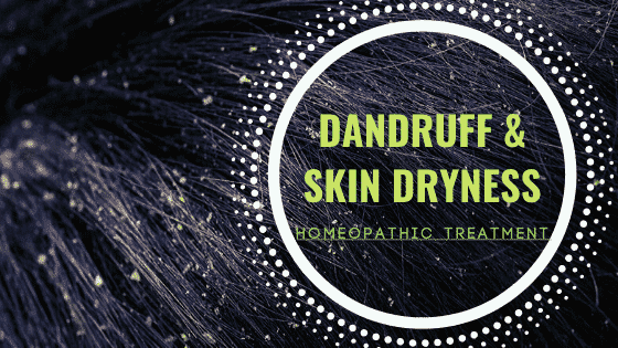Homeopathic Medicine for Dandruff Treatment
