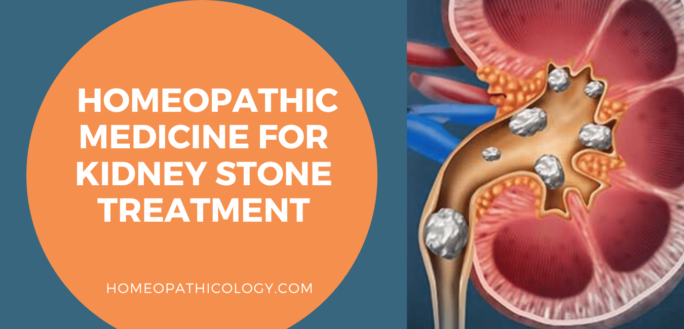 Guide: Homeopathic Medicine for Kidney Stone Treatment 1